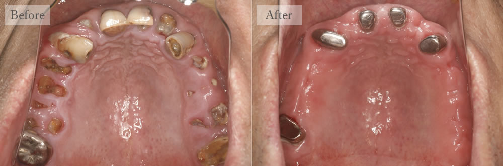 江東区大島・西大島の歯医者、あおぞら歯科の入れ歯の症例
