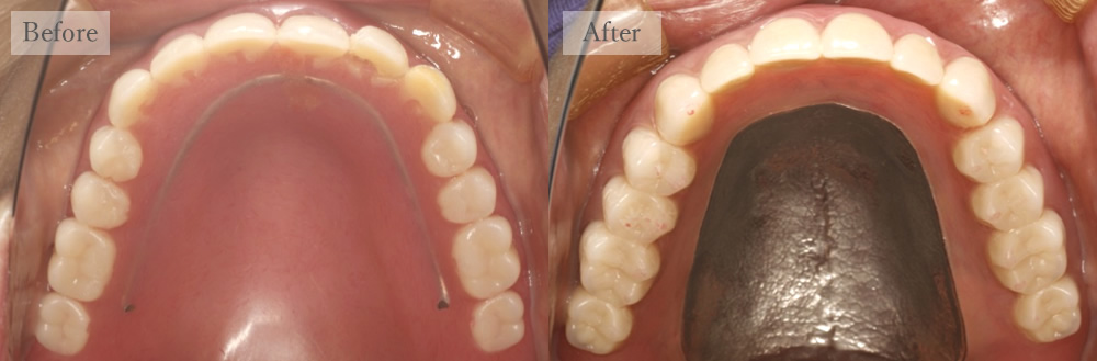 江東区大島・西大島の歯医者、あおぞら歯科の入れ歯の症例