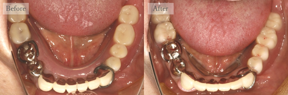 江東区大島・西大島の歯医者、あおぞら歯科の入れ歯の症例