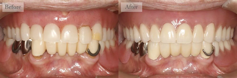 江東区大島・西大島の歯医者、あおぞら歯科の入れ歯の症例