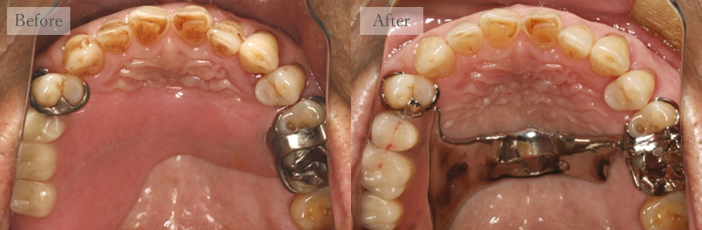 江東区大島・西大島の歯医者、あおぞら歯科の入れ歯の症例