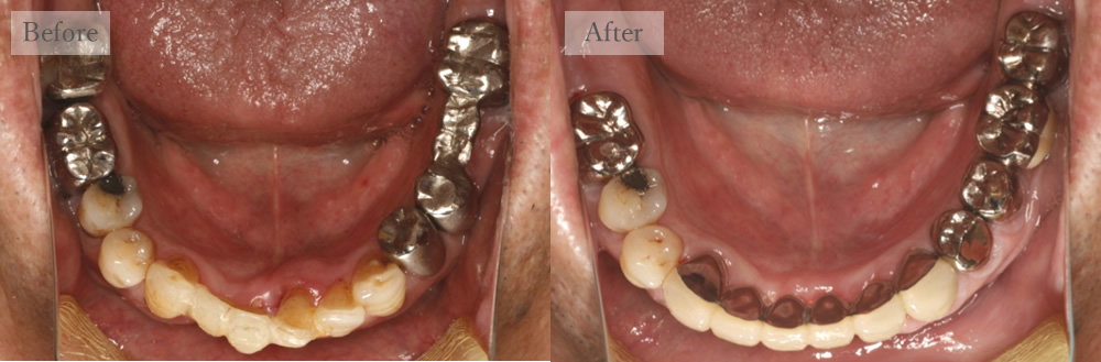 江東区大島・西大島の歯医者、あおぞら歯科の入れ歯の症例