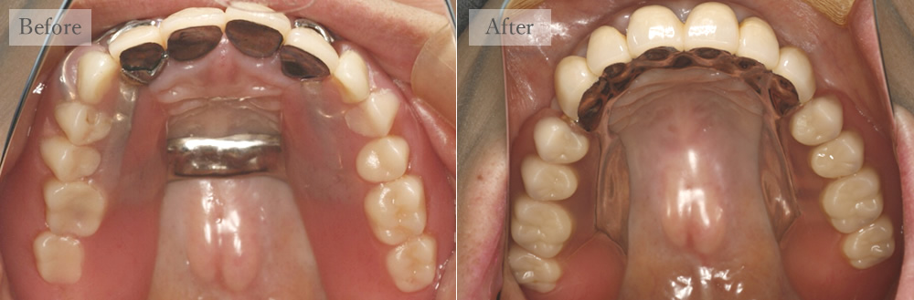 江東区大島・西大島の歯医者、あおぞら歯科の入れ歯の症例