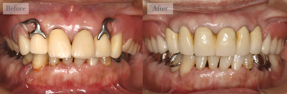 江東区大島・西大島の歯医者、あおぞら歯科の入れ歯の症例