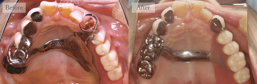 江東区大島・西大島の歯医者、あおぞら歯科の入れ歯の症例