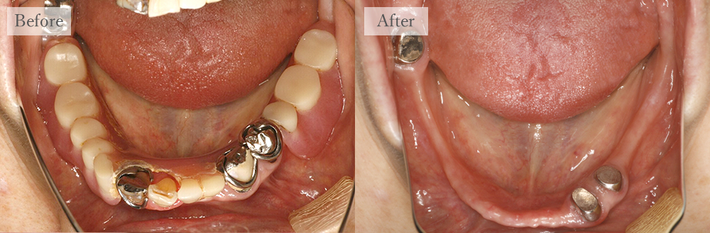 江東区大島・西大島の歯医者、あおぞら歯科の入れ歯の症例