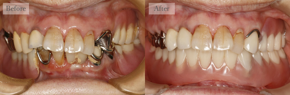 江東区大島・西大島の歯医者、あおぞら歯科の入れ歯の症例