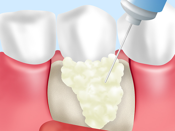 江東区大島・東大島の歯医者、あおぞら歯科の歯周病治療