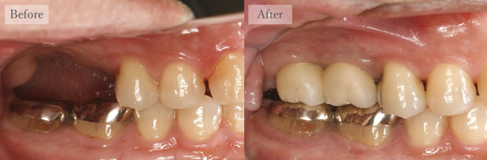 江東区大島・西大島の歯医者、あおぞら歯科のインプラントの症例