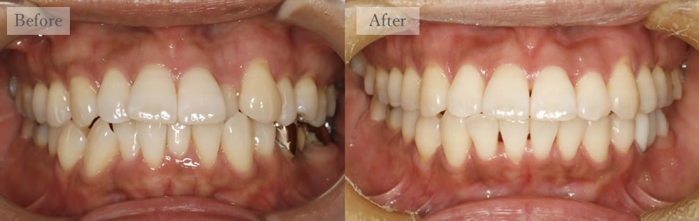 江東区大島・西大島の歯医者、あおぞら歯科の矯正治療の症例