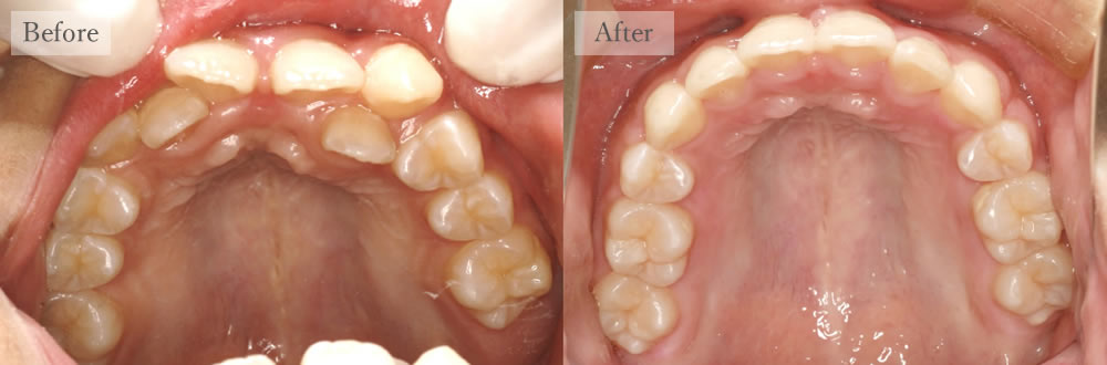 江東区大島・西大島の歯医者、あおぞら歯科の矯正治療の症例