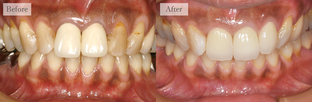 江東区大島・東大島の歯医者、あおぞら歯科の審美歯科の症例