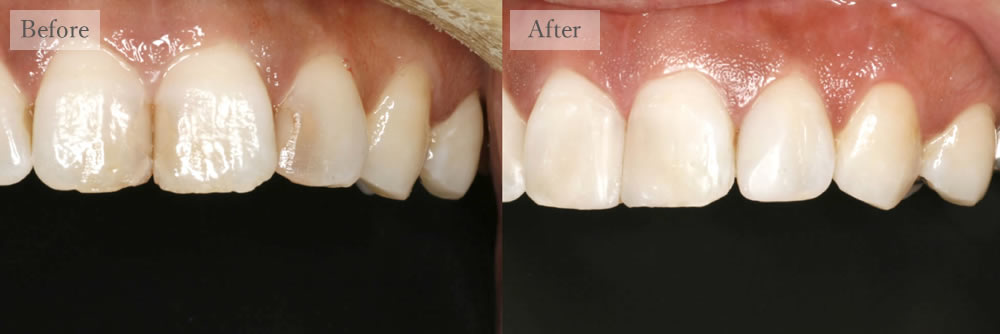 江東区大島・東大島の歯医者、あおぞら歯科の審美歯科の症例