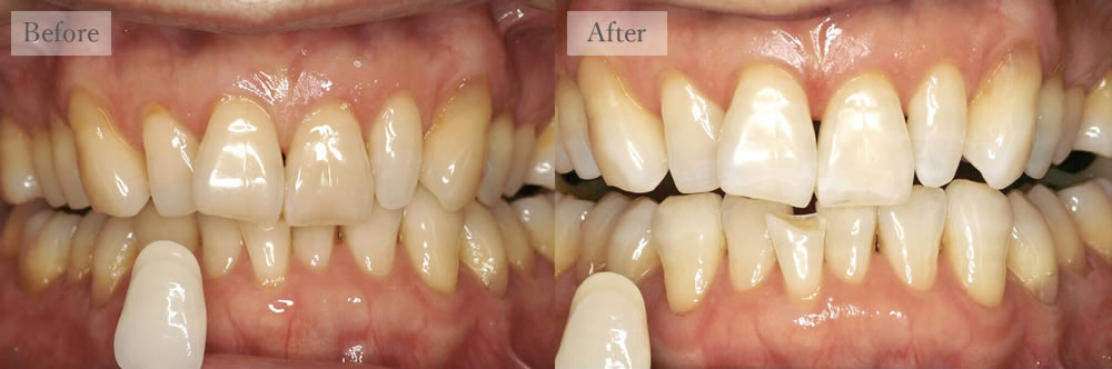 江東区大島・東大島の歯医者、あおぞら歯科のホワイトニングの症例