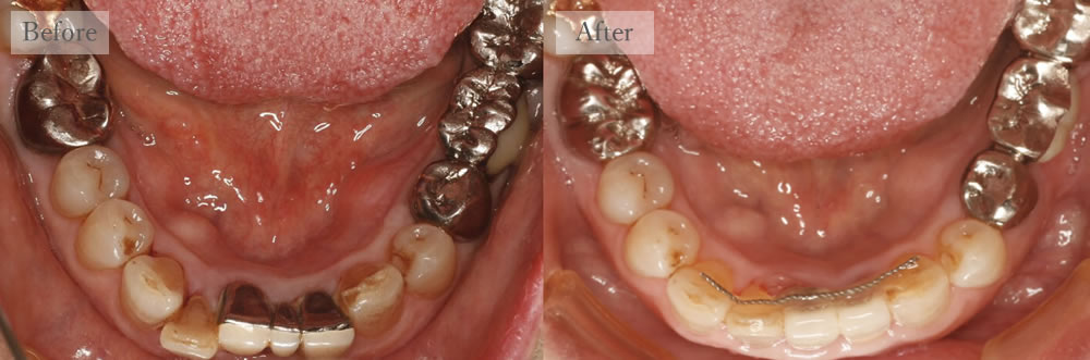 江東区大島・西大島の歯医者、あおぞら歯科の矯正歯科の症例