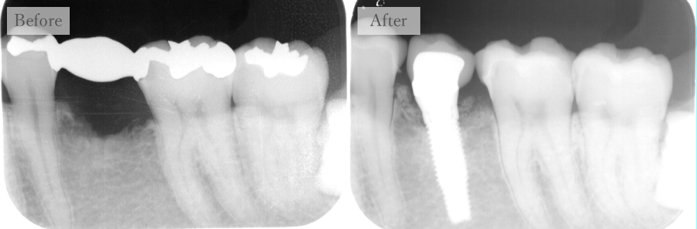 江東区大島・西大島の歯医者、あおぞら歯科のインプラントの症例
