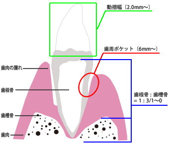 江東区大島・東大島の歯医者、あおぞら歯科の歯周病治療