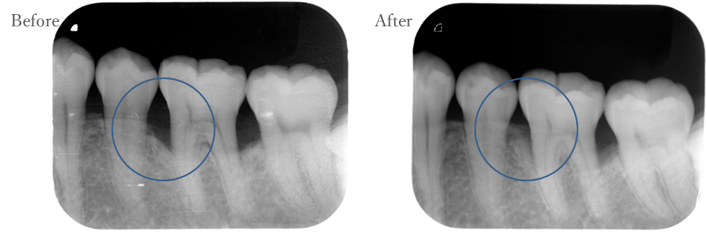 江東区大島・西大島の歯医者、あおぞら歯科の虫歯治療の症例