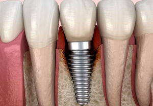 インプラントのメンテナンス頻度と長持ちさせる秘訣を解説