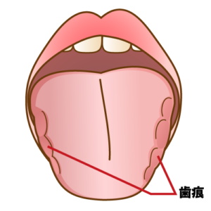 自分でできる歯ぎしりチェック方法と日常での予防法を解説