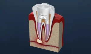 大島・東大島の歯医者、あおぞら歯科で、嚢胞（のうほう）が見つかった時の一般的な治療方法とは？原因や予防法も解説